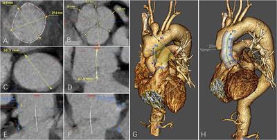 Anatomical Feasibility Study on Novel Ascending Aortic Endograft With More Proximal Landing Zone for Treatment of Type A Aortic Dissection